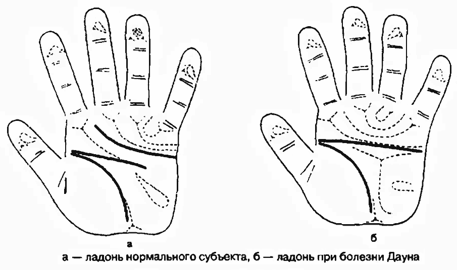 Сравнение ладоней нормального человека и дауна Дерматоглифическое сравнение ладоней нормального человека и страдающего синдромом Дауна
